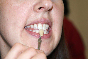 Teeth Whitening Results Cork
